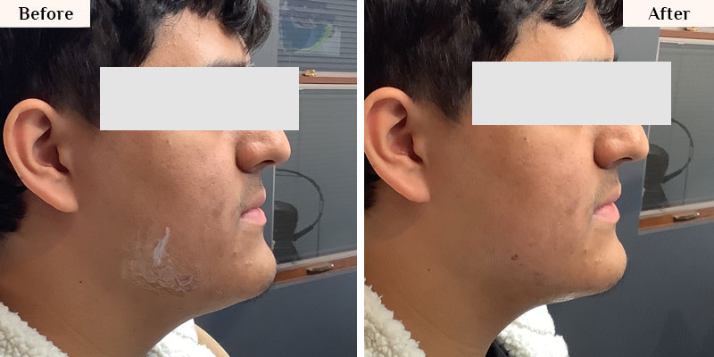 Jawline enhancement with fillers